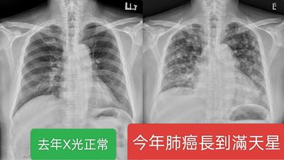 他每年照X光竟肺癌末期　醫：千百顆滿天星到處轉移了