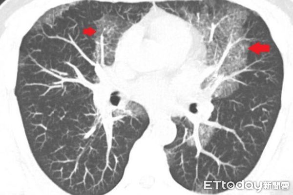 肺部蛋白質沉積症大白肺。（圖／台北慈濟醫院提供）