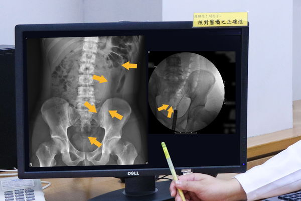▲▼宜蘭男子35公分長按摩棒卡腸，造就羅東博愛醫院創下全台首例經自然孔道（肛門）移除乙狀結腸大型異物的紀錄。（圖／羅東博愛醫院提供，下同）