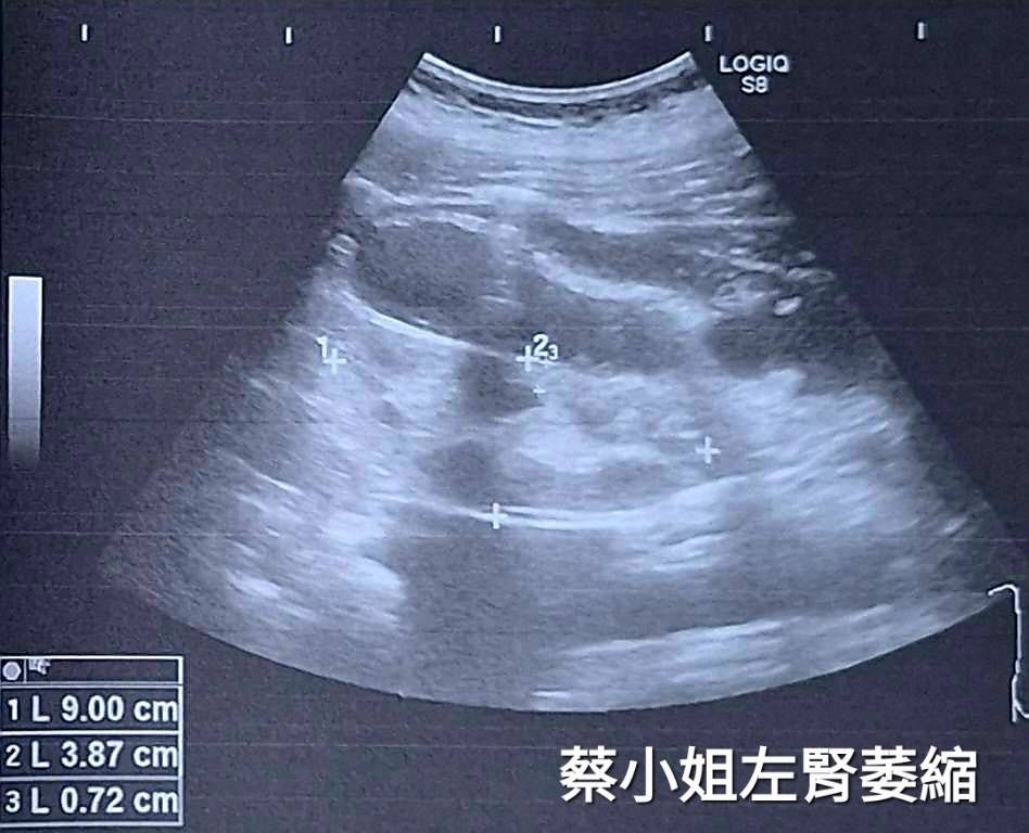 ▲▼糖尿病年輕化。（圖／記者許宥孺翻攝）