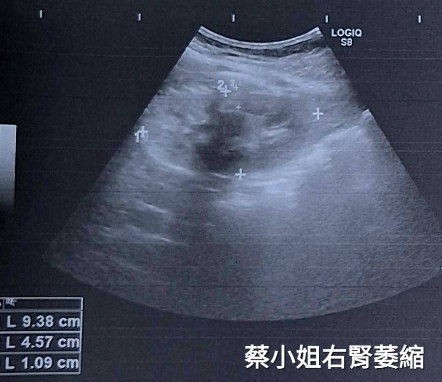 ▲▼糖尿病年輕化。（圖／記者許宥孺翻攝）