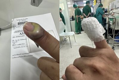 被貓抓傷險截肢！寵物美容師「手指整塊化膿」　恐怖感染照曝