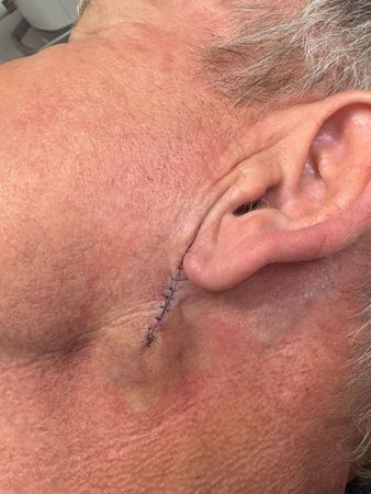 ▲▲「地獄廚神」戈登拉姆齊（Gordon Ramsay）罹患「基底細胞癌」。（圖／翻攝自IG）