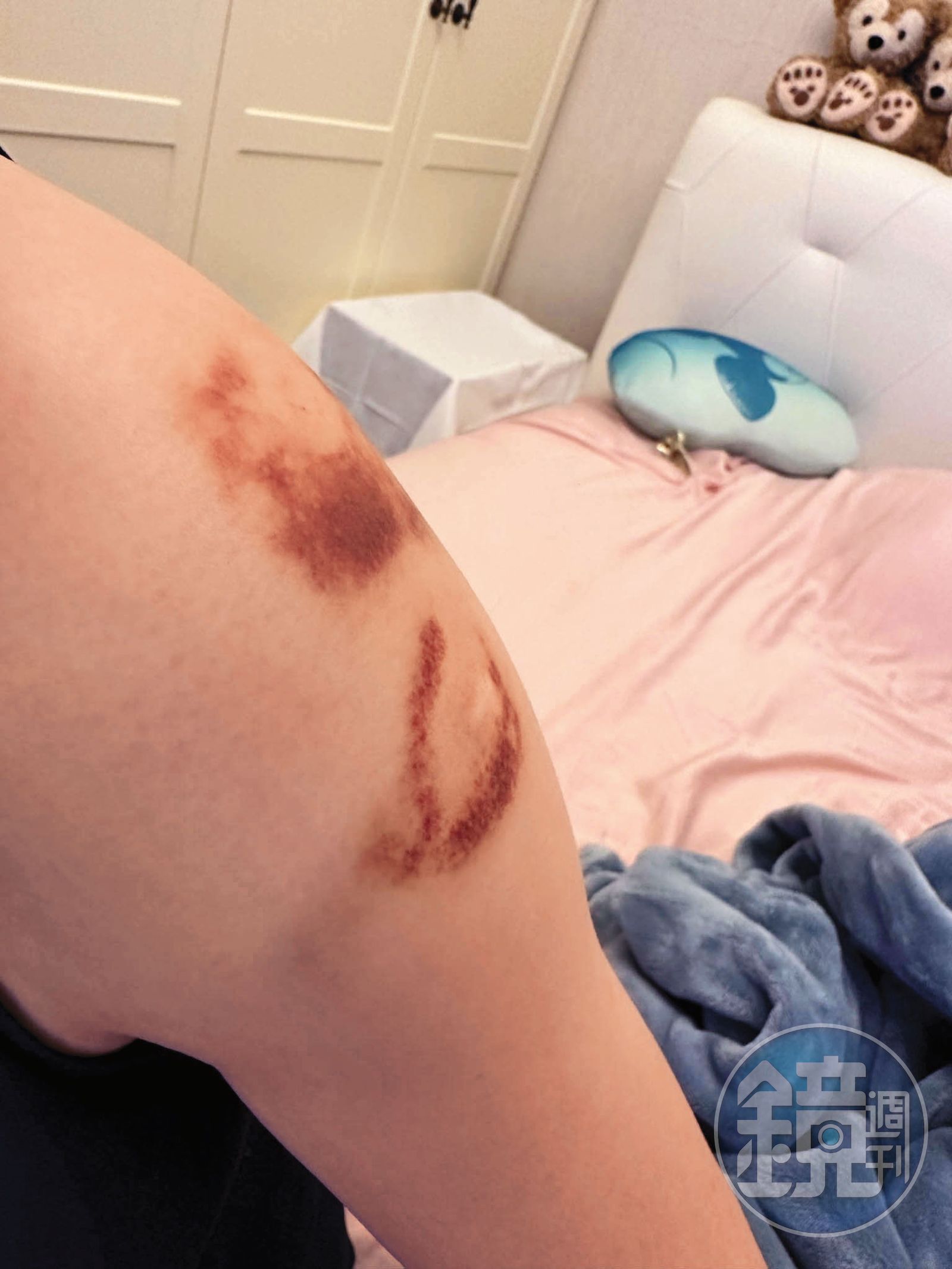 張妻（圖）與丈夫發生衝突，傷痕累累，最後聲請保護令獲准。（讀者提供）