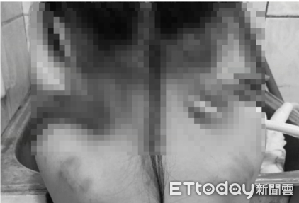 ▲台東縣關山國小學前特幼班虐童，幼童背上大片瘀青。（圖／記者楊漢聲翻攝）