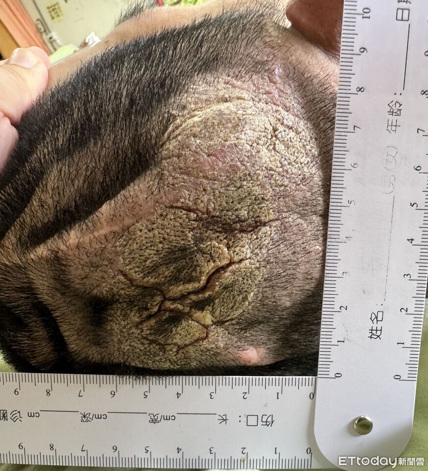 新營醫院首例「在宅急症照護」成功　36歲患者居家康復成典範
