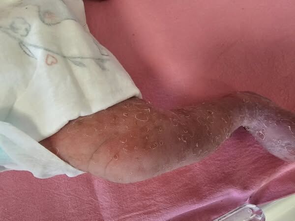 ▲▼醫師根據新生兒皮膚上佈滿有如小水泡般的紅疹，診斷罹患色素失調症。（圖／亞大醫院提供）