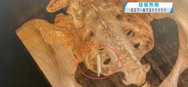 ▲▼體溫計斷在武漢女子體內22年。（圖／翻攝極目新聞）