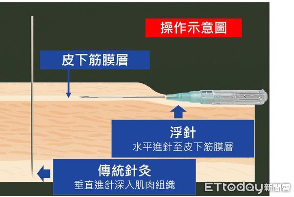 ▲▼  浮針           。（圖／周立偉醫師提供）