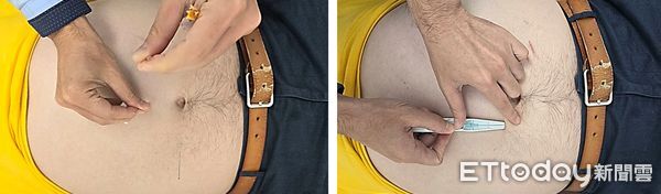 ▲▼      浮針       。（圖／周立偉醫師提供）