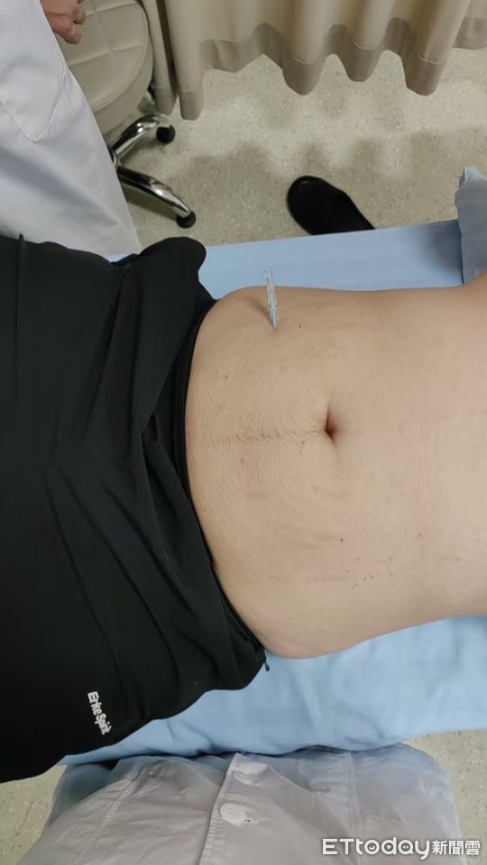 ▲▼      浮針       。（圖／周立偉醫師提供）