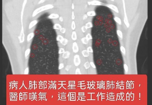 ▲六旬女檢出肺部滿天星毛玻璃肺結節。（圖／翻攝自蘇一峰臉書）