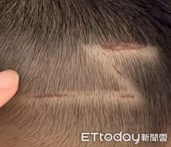 5歲兒剃帥氣「閃電髮」！慘被割破頭皮發炎掛急診...媽媽怒了