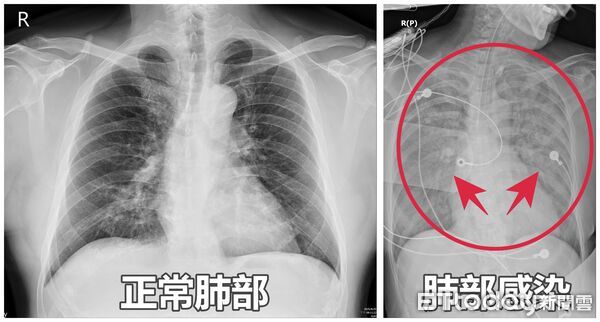 ▲七月撞邪「靈魂出竅」？醫：比鬼更猛的「隱形殺手」　65歲婦雙肺全白險喪命。（圖／亞大附醫提供）