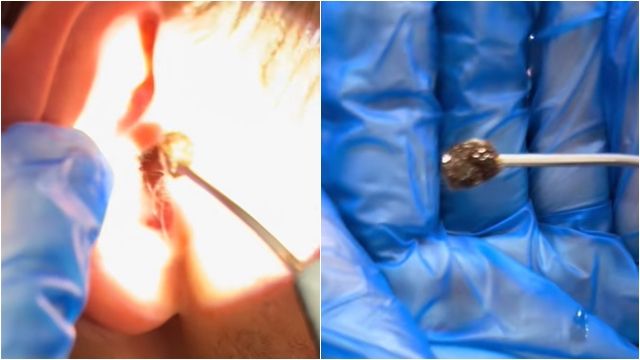 ▲▼瘋狂耳鳴聽不到！　他耳朵挖出「超巨大耳屎」影片曝光。（圖／翻攝TikTok）