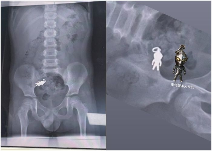 （超人力霸王）▲▼男童誤吞「奧特曼吊飾」，家人鬆一口氣：任務完成。（圖／網友shushu1011授權）