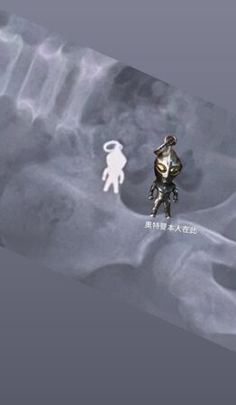 ▲▼X光片顯示宜蘭7歲男童誤吞的奧特曼吊飾。（圖／翻攝自threads，下同）