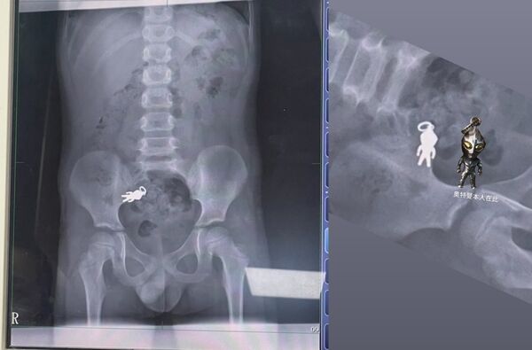 ▲▼X光片顯示宜蘭7歲男童誤吞的奧特曼吊飾。（圖／翻攝自threads，下同）