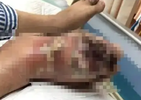 ▲吳先生的右腳大面積潰爛。（圖／翻攝自微博）
