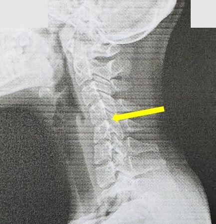 ▲▼20歲女大學生的頸椎因長期低頭滑手機，呈現滑脫的情況。（圖／員榮醫院提供）