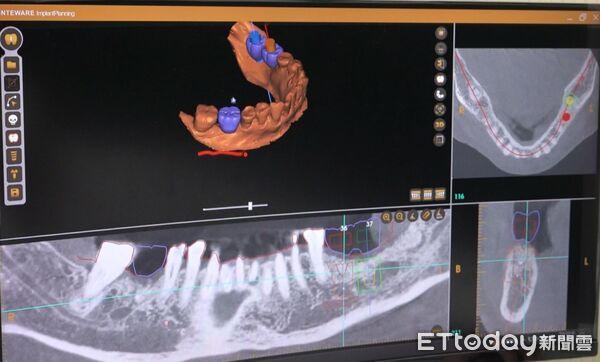 ▲▼  嘉基數位導航精準植牙打造幸福好口福 。（圖／嘉義基督教醫院提供）