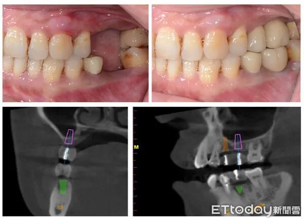 ▲▼  嘉基數位導航精準植牙打造幸福好口福 。（圖／嘉義基督教醫院提供）