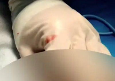 蛋沒了！少年割包皮半月後「睪丸壞死」　院方：手術工具臨時買的