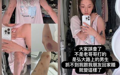 46萬正妹YTR在韓國「拒絕陪睡」被暴打　骨折瘀青照曝：警察超爛
