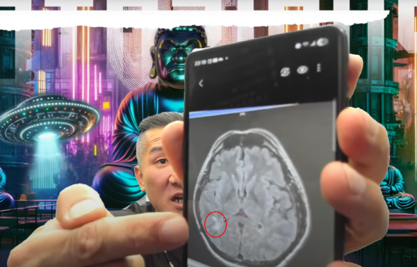 ▲館長在直播中秀出X光片，顯示部分血管「不見了」。（圖／翻攝自YouTube／館長惡名昭彰）