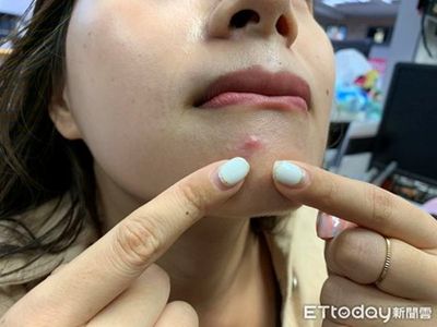 從滿臉痘到光滑肌!醫師解析口服A酸「膠囊優勢+真實案例」安心療程告別痘痘肌