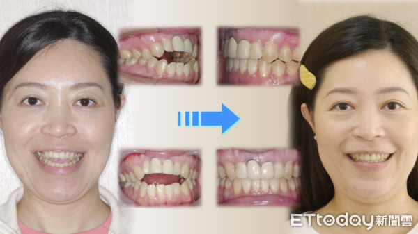 ▲黃小姐矯正前的牙齒連土司都咬不斷            。（圖／記者吳奕靖翻攝）
