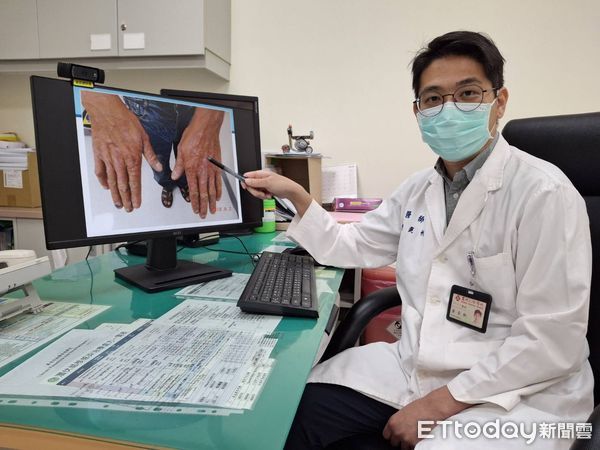 ▲乾癬恐致關節。（圖／記者楊晨東翻攝）