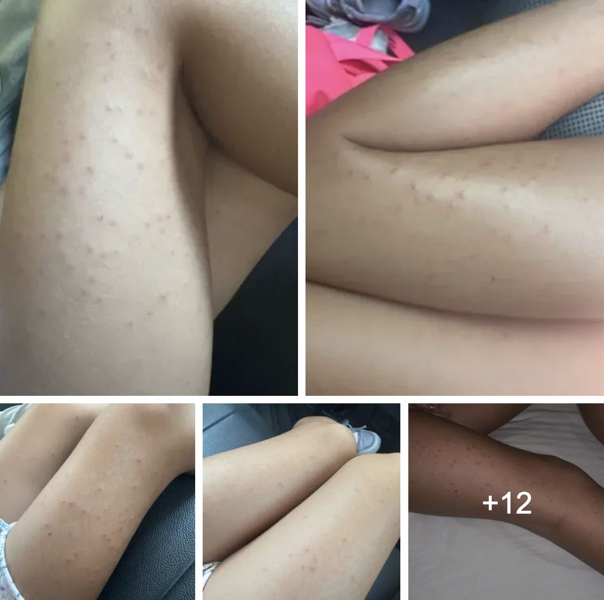 ▲一名來自日本的單親媽媽指控，今年8月攜帶3歲與6歲兩名子女赴台旅遊，入住雲品溫泉酒店期間，疑遭「床蝨」叮咬，且遭飯店冷處理。（圖／翻攝自爆料公社）