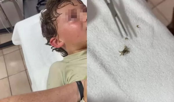 男童海邊遊玩覺得耳內有東西在動　醫夾出「活跳跳螃蟹」畫面曝。（圖／翻攝自TikTok／kitziamitre）