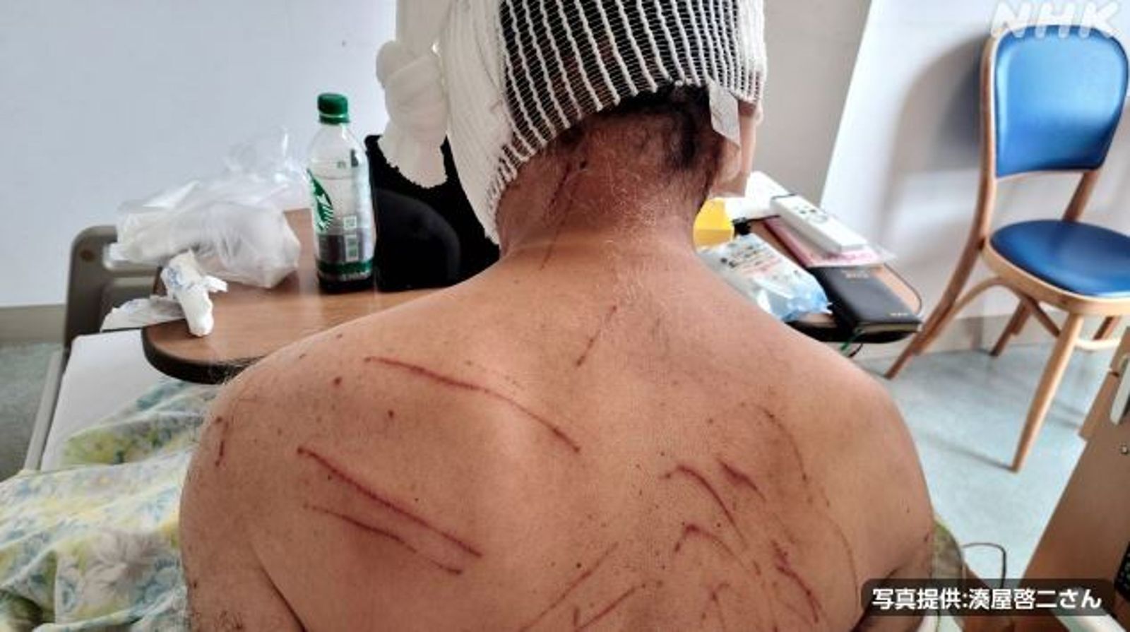 「做好必死覺悟」他遭熊狂襲縫60針倖存　至今飽受傷痛折磨留陰影