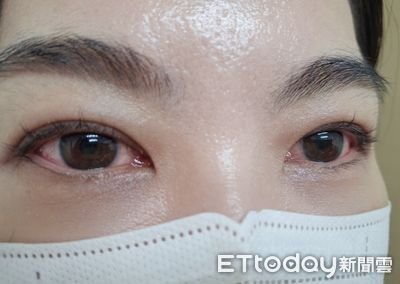 眼睛疼痛紅腫需專業診治　防止傳染風險