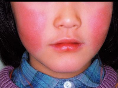 赴日注意!沖繩那霸爆「蘋果病」疫情 孕婦感染恐流產