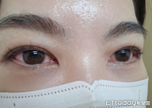 ▲▼  眼睛紅癢流淚？小心不是過敏　恐是「急性結膜炎」找上門  。（圖／嘉義基督教醫院提供）