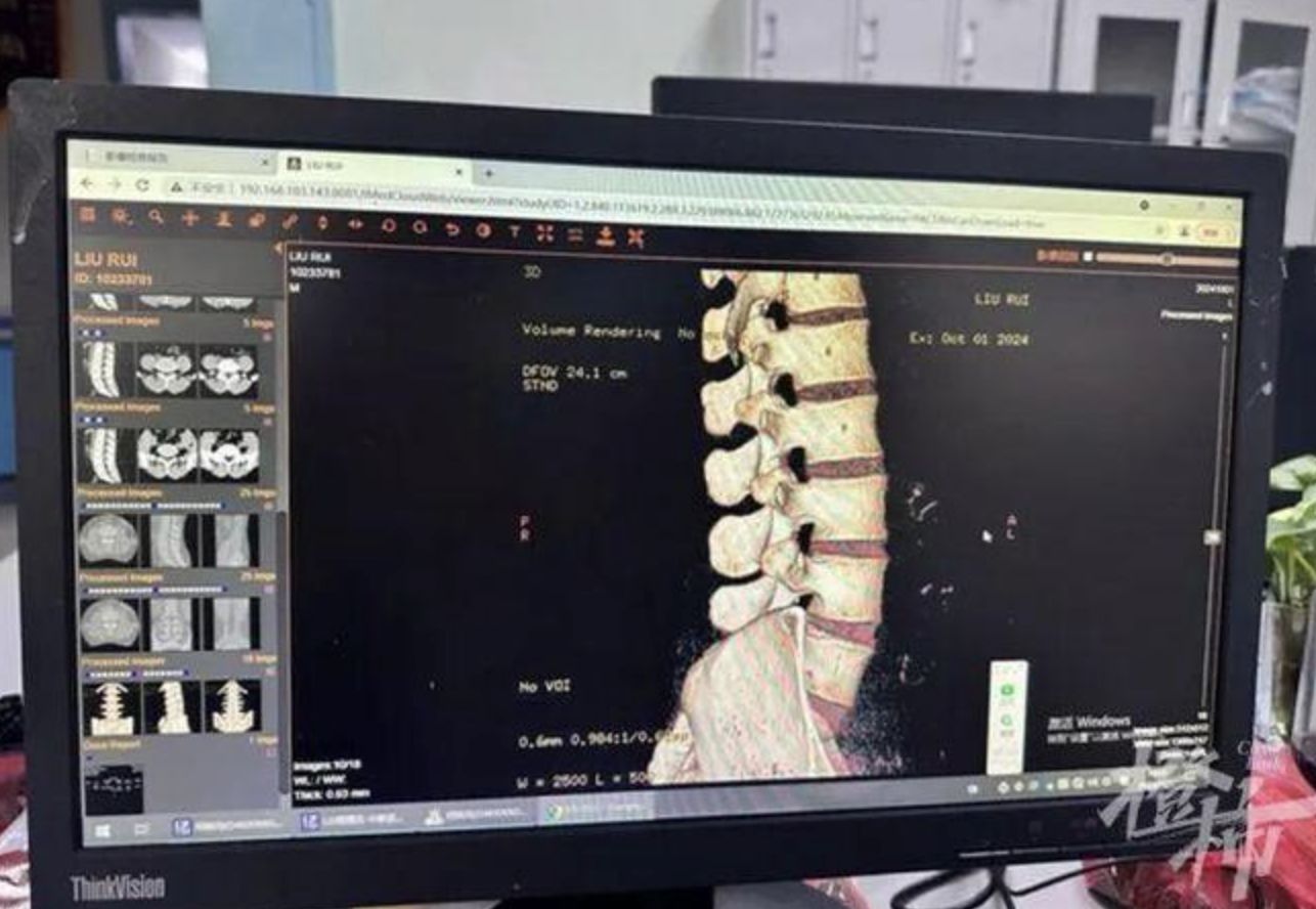 ▲男子衝浪不慎，脊髓受損。（圖／翻攝都市快報）