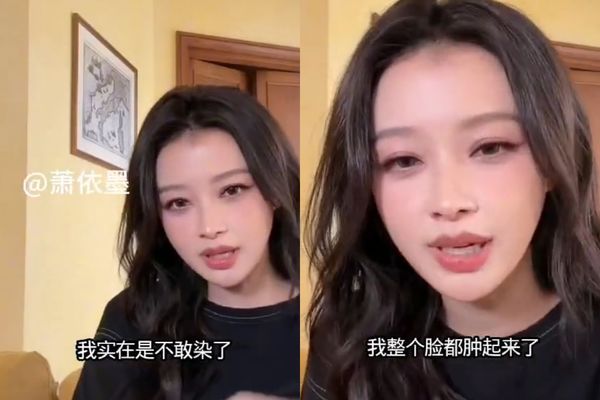 ▲▼《羋月傳》孫怡染髮「臉腫到不能見人」　住院吊點滴2天：暫時不敢了。（圖／翻攝自微博）