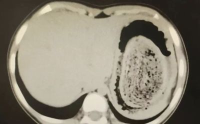 陸10歲女孩患「長髮公主症候群」 就醫發現:成團頭髮塞滿3/4個胃