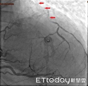 38歲女搭捷運暈倒「三條冠狀動脈全塞」 醫示警:心肌梗塞年輕化