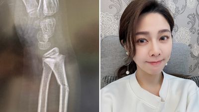 白家綺6歲兒「上學被絆倒」右手骨折！心疼還原過程：重重摔下去