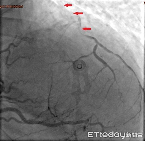 38歲女性三條冠狀動脈全部阻塞。（圖／台北慈濟醫院提供）