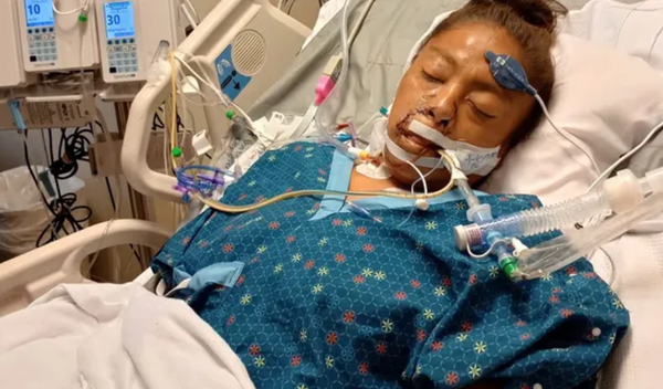 女被比特犬拖下單車狠咬「痛失雙臂雙腿」　男友當場擊斃惡犬。（圖／翻攝自募款網站GoFundMe）