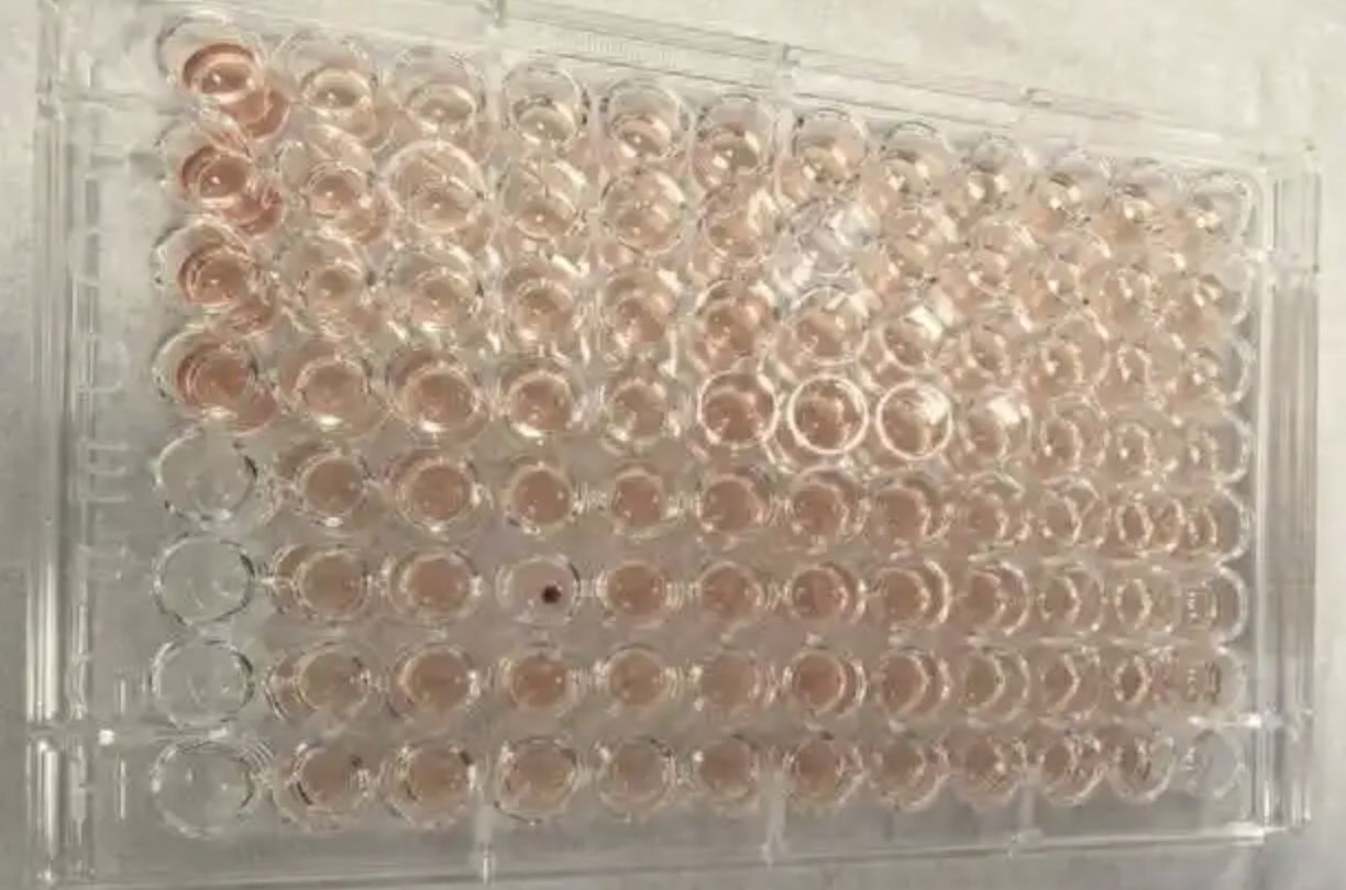 ▲廣東順德發現更為罕見的「鑽石血」擁有者。（圖／翻攝封面新聞）