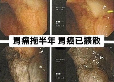 35歲女胃痛拖半年　醫：癌細胞擴散整個腹腔