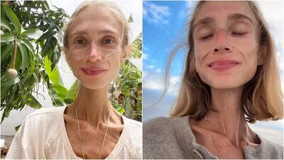 瘦成骷髏只剩22公斤！　素食女「只吃水果」活活餓死