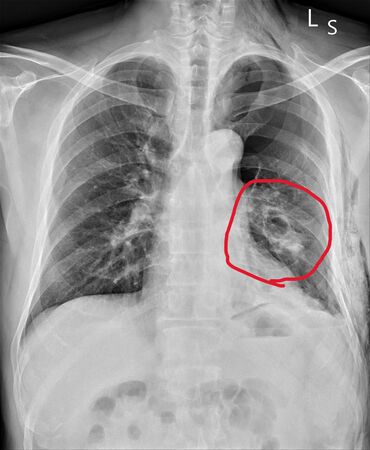 ▲▼員榮醫療體系員榮醫院急診室翁聖富醫師解釋，張姓患者脾臟(圖中紅圈)破裂的情況。（圖／員榮醫院提供）