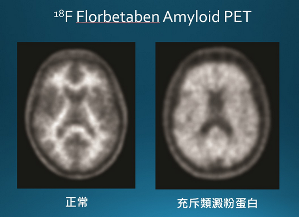 ▲阿茲海默症早篩早治守護腦健康